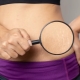 What helps with stretch marks?